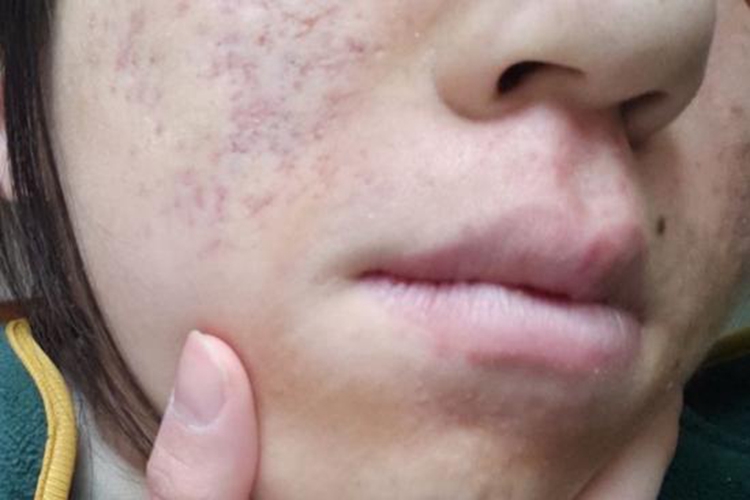 痘痘消退后局部色素沉着图