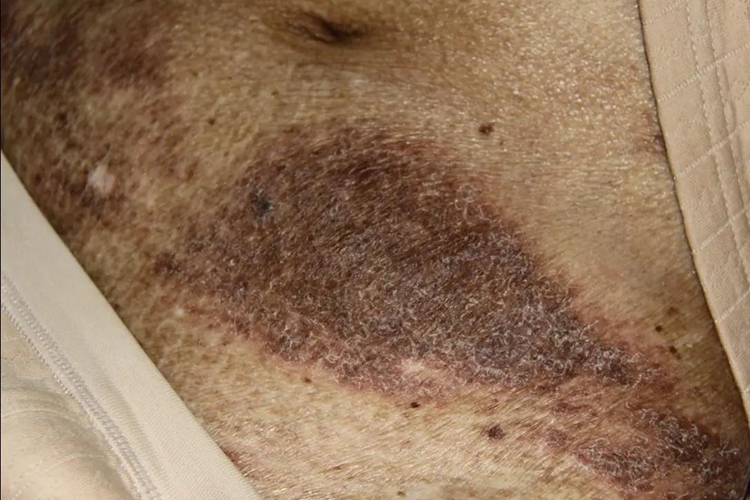 腹部色素沉着伴角化过度图