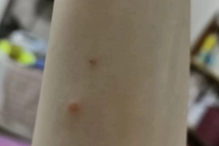 皮肤纤维瘤胳膊结节图 皮肤纤维瘤胳膊结节图