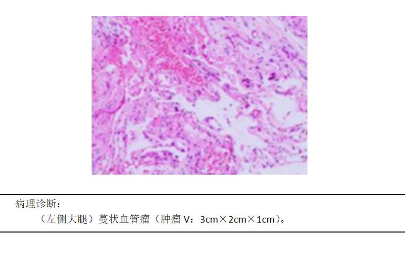 女子左腿酸痛确诊蔓状血管瘤，积极治疗很快痊愈！.jpg