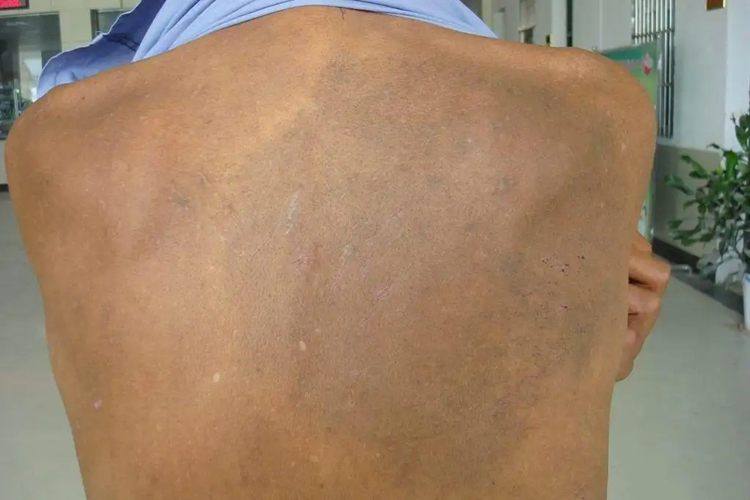 摩擦黑变病图 摩擦黑变病图