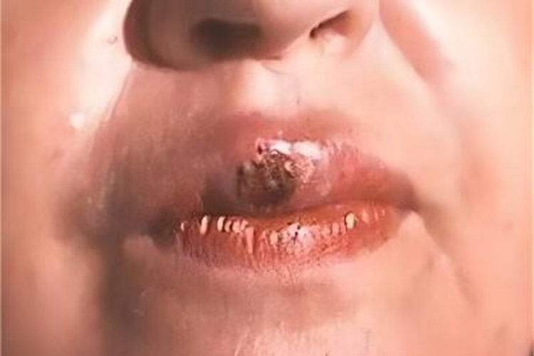 早期性病性淋巴肉芽肿症状图