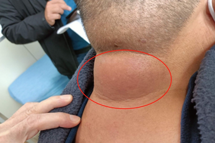 硬肿病后颈症状图