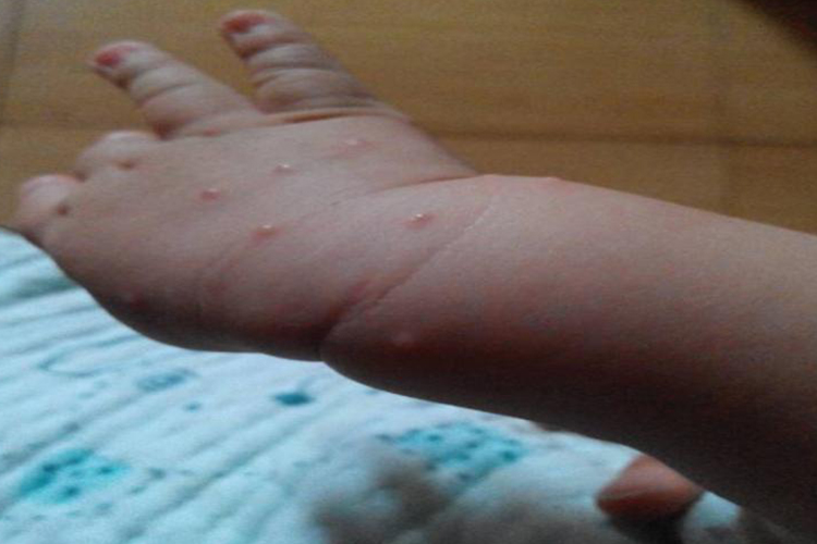 水痘手上起小疙瘩图