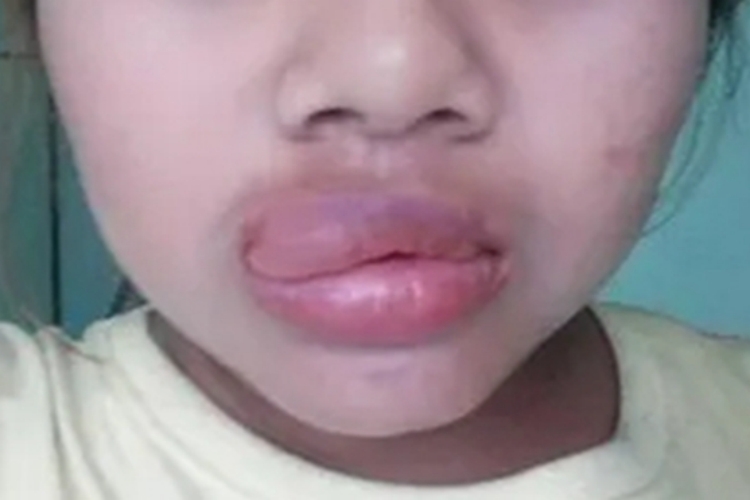 海鲜过敏嘴唇红肿图