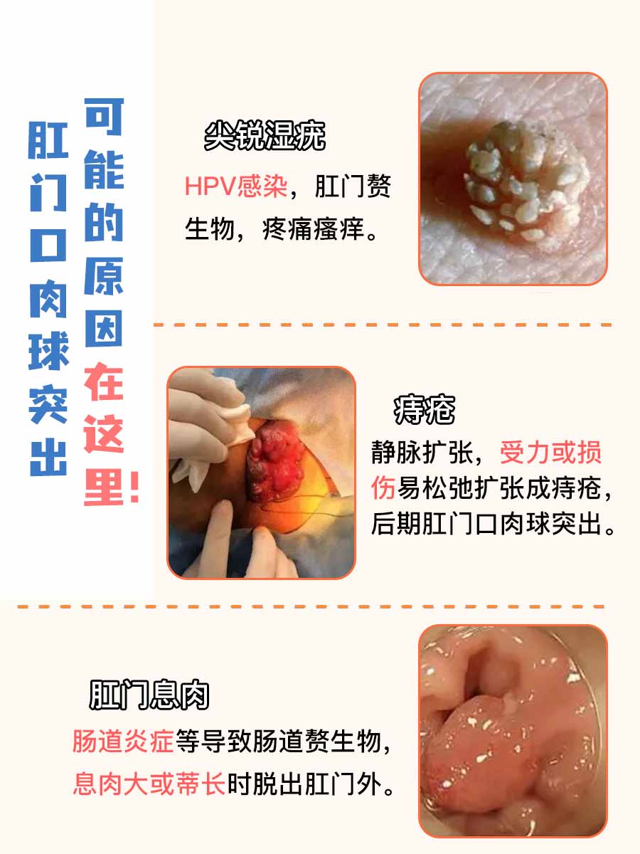 肛门口肉球突出？原因速看！