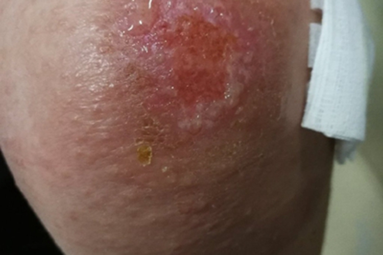 自身敏感性皮炎膝盖症状图