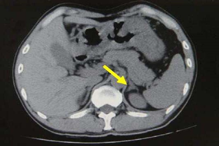 肾上腺增大CT表现图