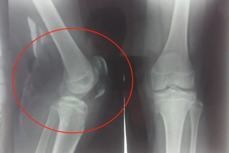 胫骨结节撕脱性骨折图