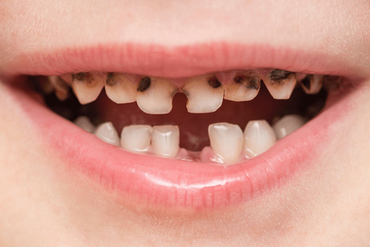 儿童牙齿酸蚀症图