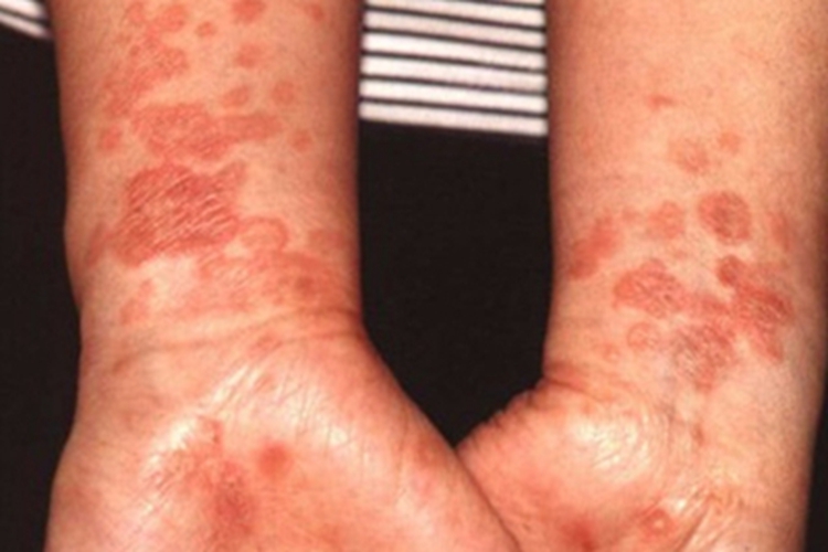 男性三期梅毒胳膊红斑图