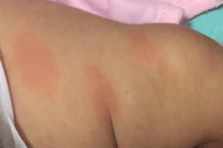 婴儿钱币状湿疹图 婴儿钱币状湿疹图