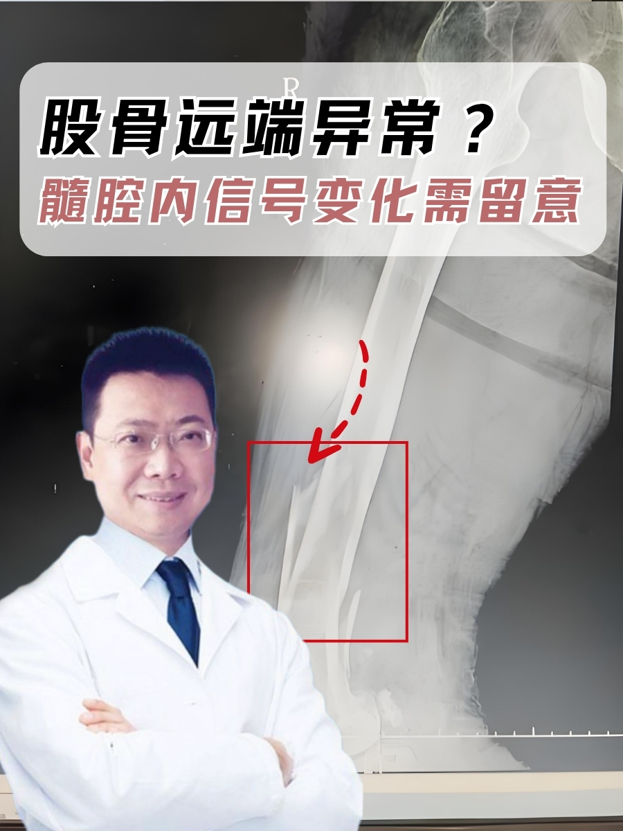 股骨远端异常？髓腔内信号变化需留意