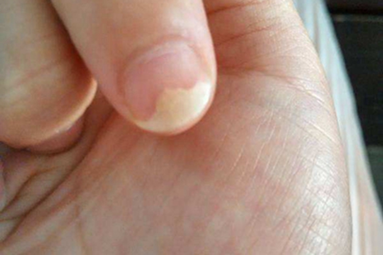 脱甲病指甲间空了一块图 脱甲病指甲间空了一块图