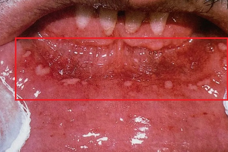 疱疹样型复发性阿弗他溃疡图