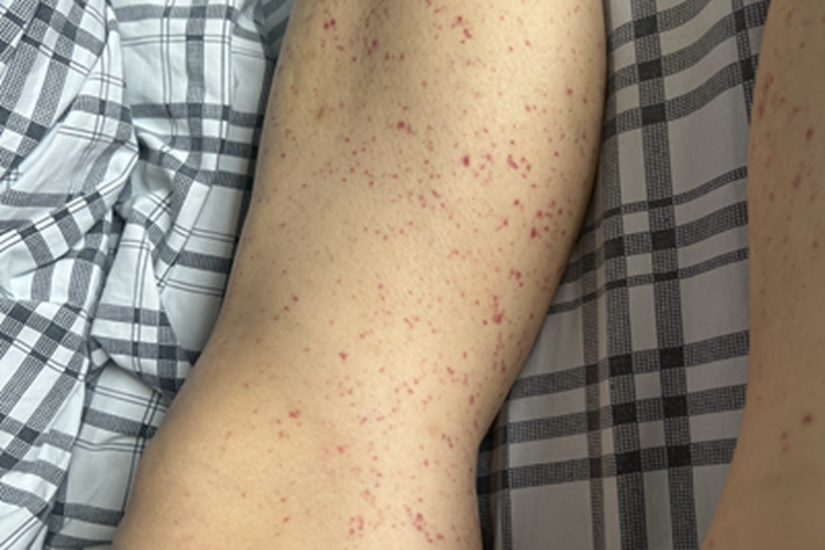 单纯性紫癜小腿有瘀斑图 单纯性紫癜小腿有瘀斑图