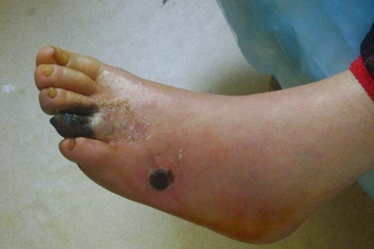 干性坏疽脚趾皮肤发黑图 干性坏疽脚趾皮肤发黑图