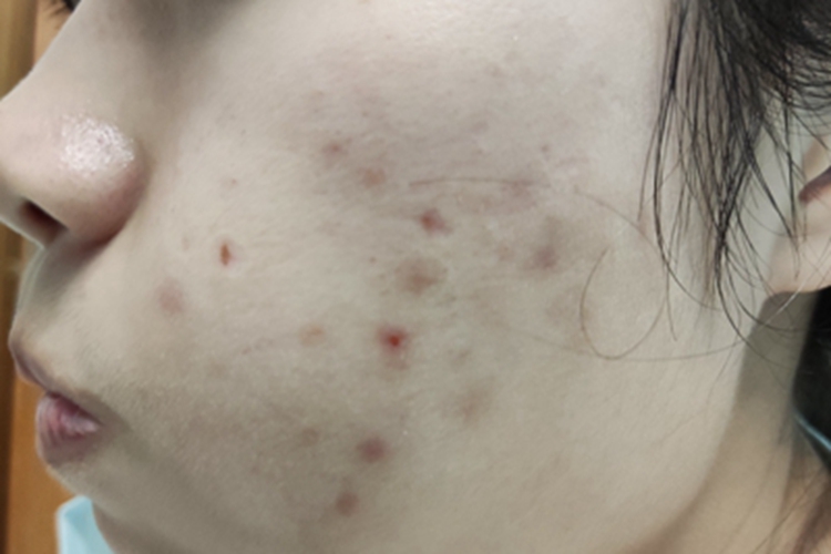 痤疮左侧脸颊上有褐色斑片图