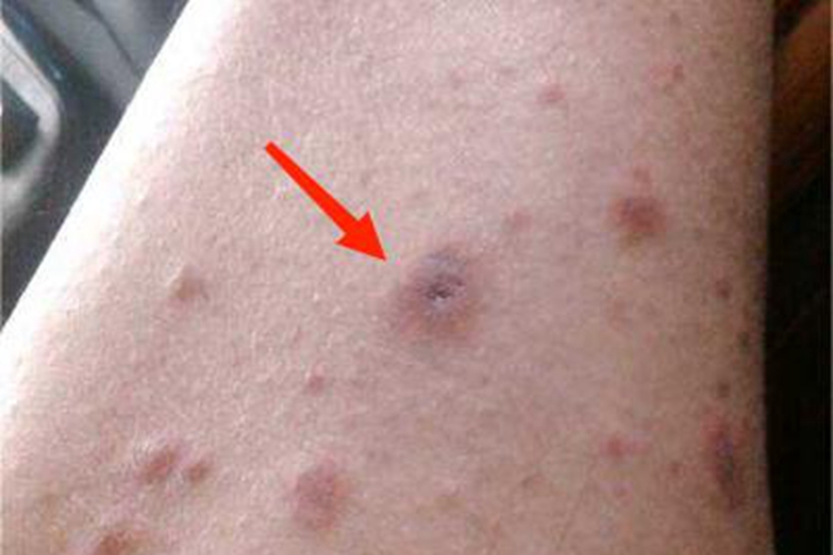 淋巴瘤样丘疹病瘢痕图 淋巴瘤样丘疹病瘢痕图