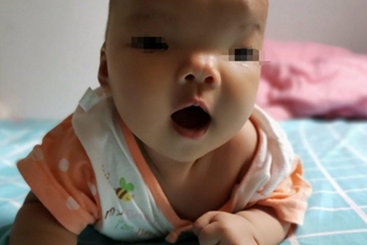 5P-综合征面部特殊面容图 5P-综合征面部特殊面容图