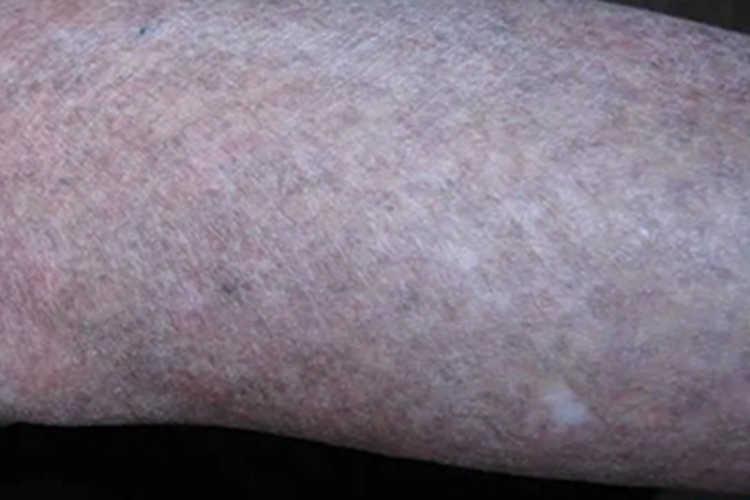 先天性皮肤异色病胳膊症状图