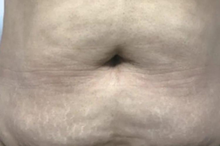 妊娠纹腹部有好多白色的纹图