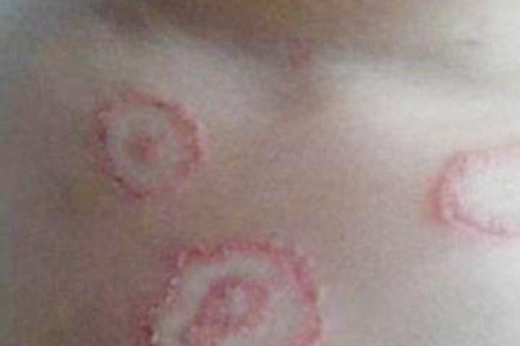 胸口体癣圆形红斑图