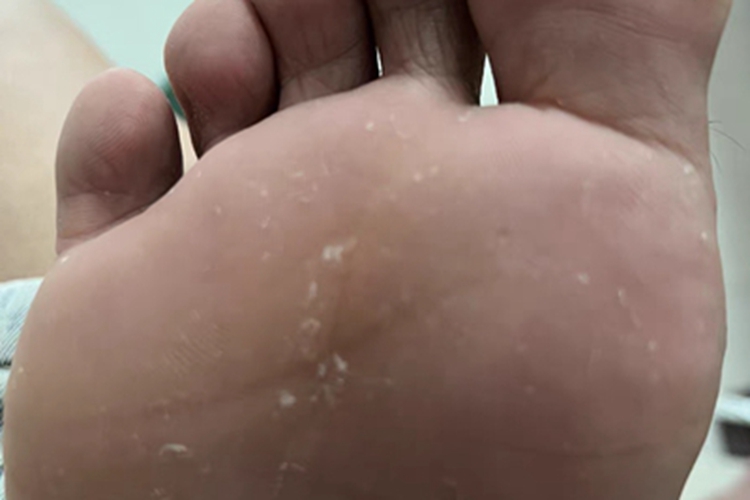 水疱型足癣脚底少量脱皮图 水疱型足癣脚底少量脱皮图