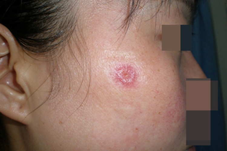 固定型皮肤型孢子丝菌病症状图 固定型皮肤型孢子丝菌病症状图