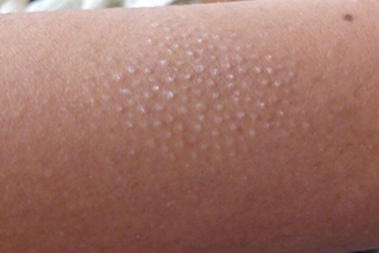 小棘苔藓小疙瘩图 小棘苔藓小疙瘩图