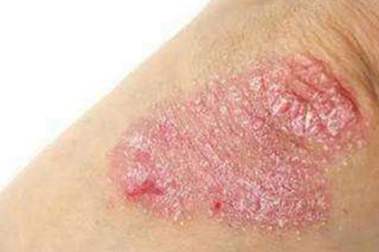 斑状淀粉样变肘部脱屑图