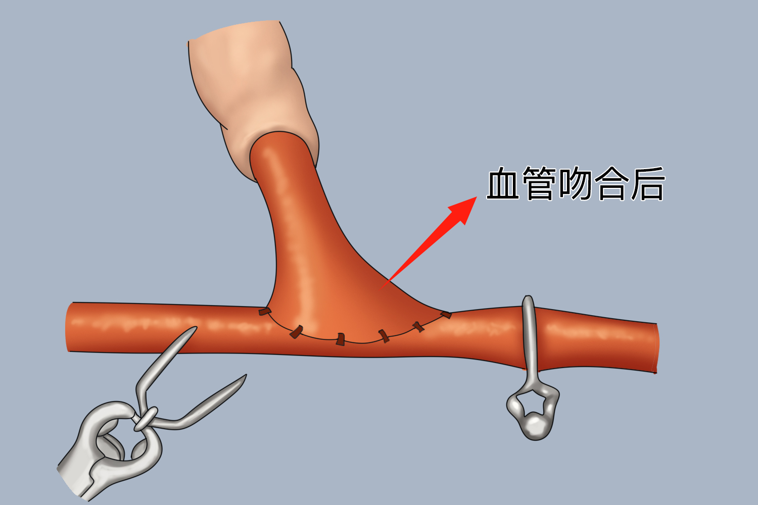 冠状动脉旁路移植术血管吻合后图