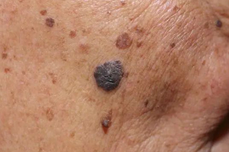 恶性雀斑样痣面部症状图