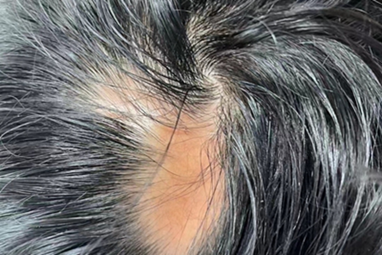 硬皮病头皮症状图