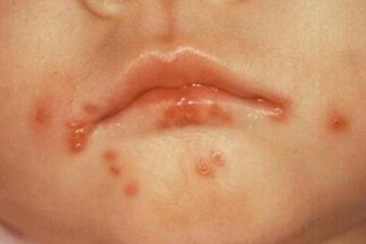 单纯疱疹口周起红斑水疱图