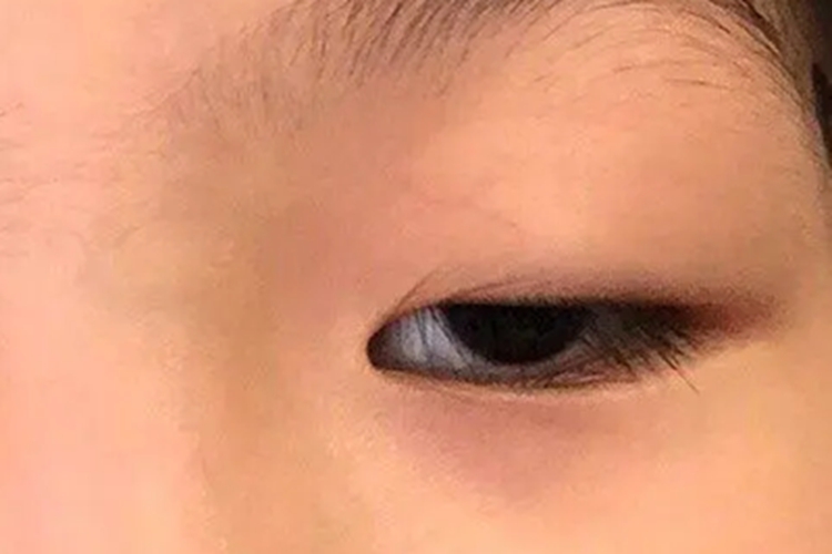 上睑下垂症状图