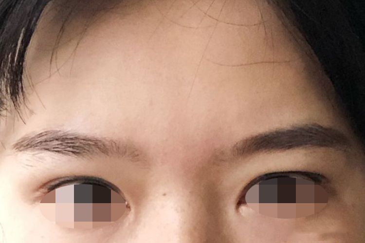 重睑线过窄图