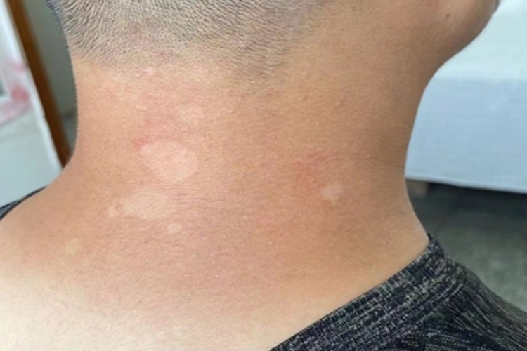 花斑糠疹脖子上有几个白斑图