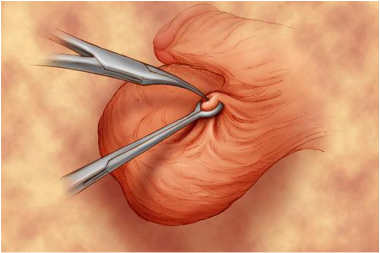 男人输精管结扎术切口位置图