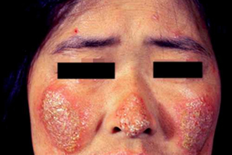 女性盘状红斑狼疮图