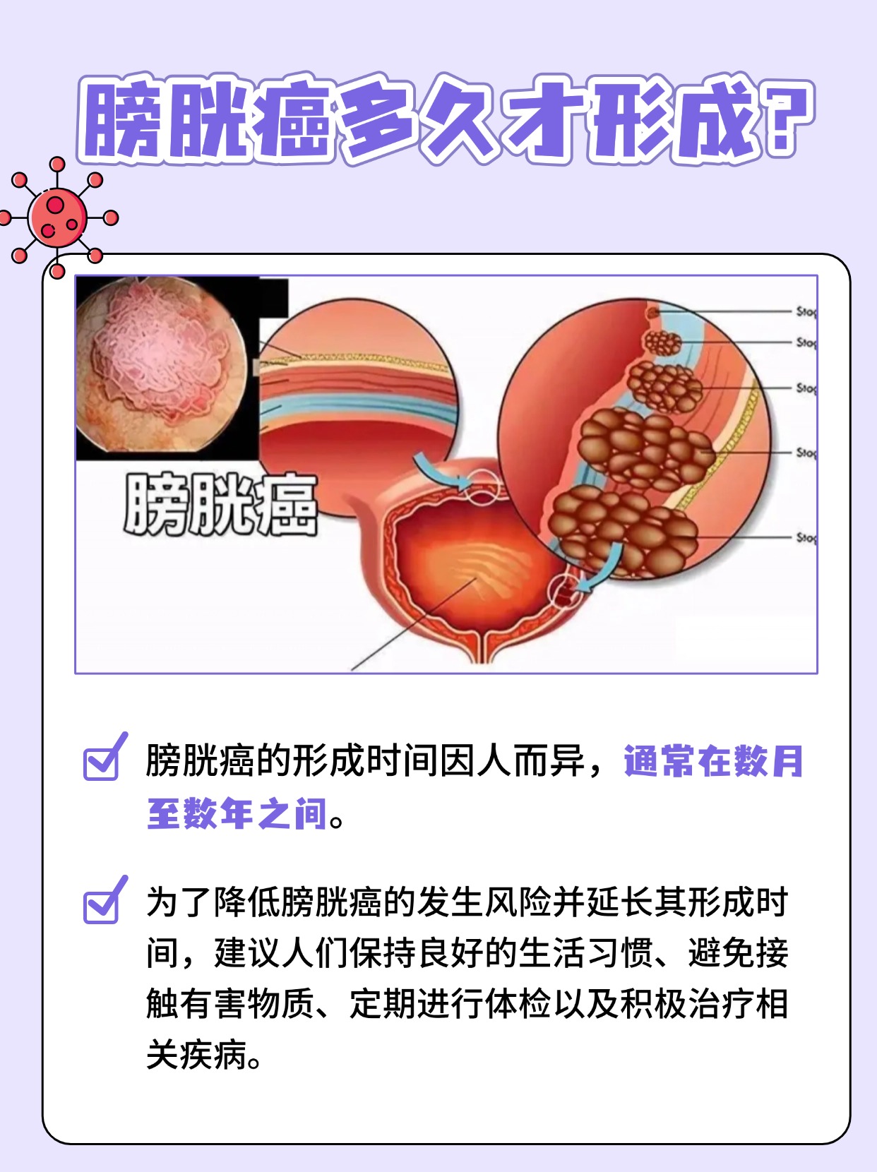 膀胱癌的形成之旅：探究形成时间