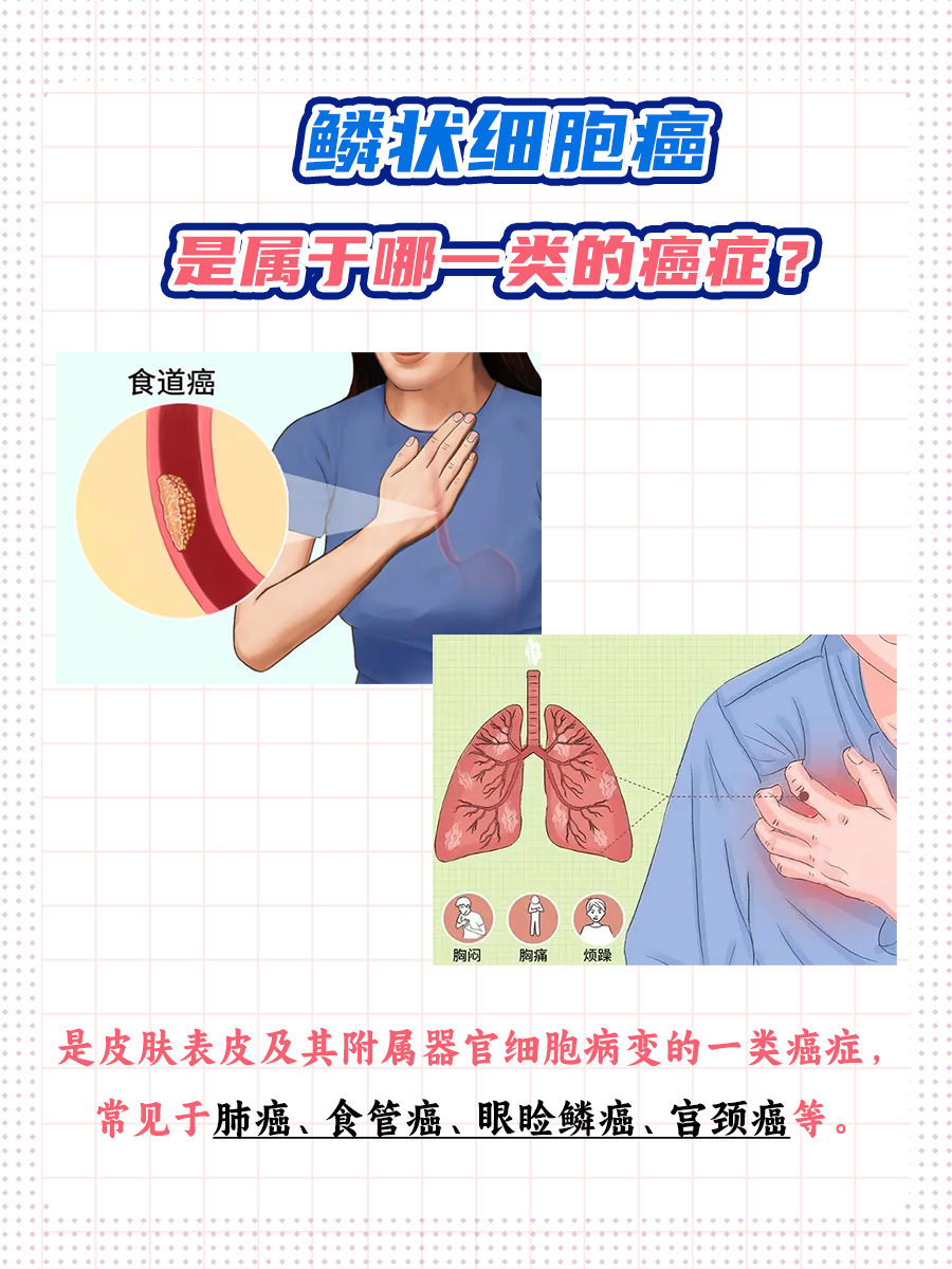 一文带你了解高、中分化鳞状细胞癌的阶段！