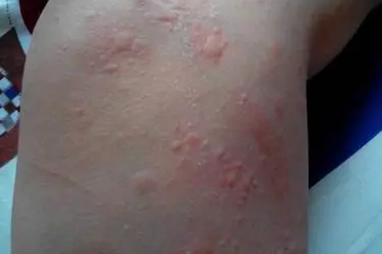 蚕丝被过敏腿部丘疹图 蚕丝被过敏腿部丘疹图