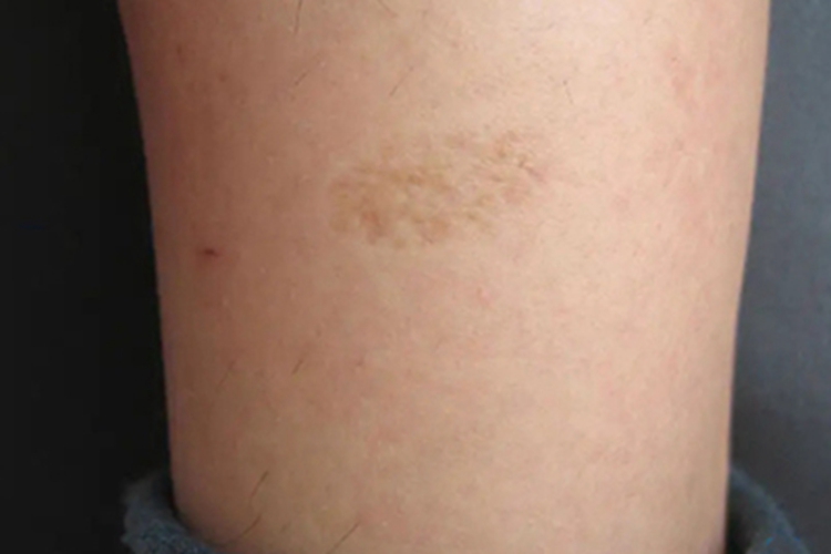 斑状萎缩症状图