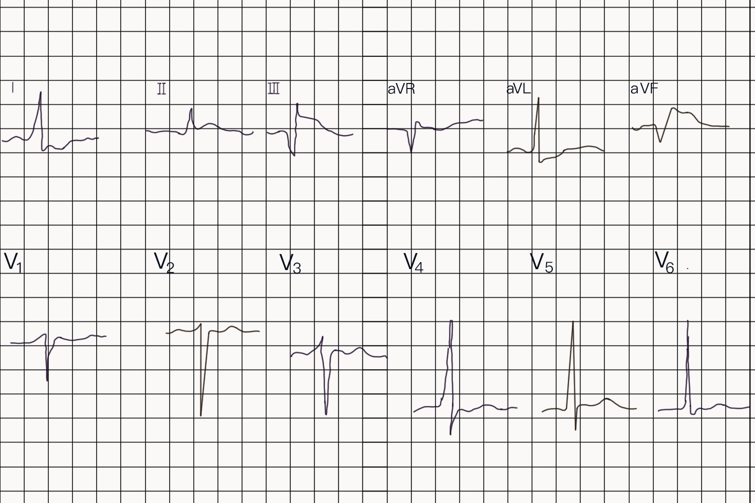 急性下壁心肌梗死心电图