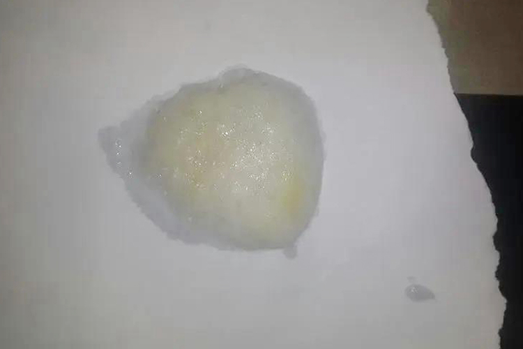 慢性支气管炎黄痰图