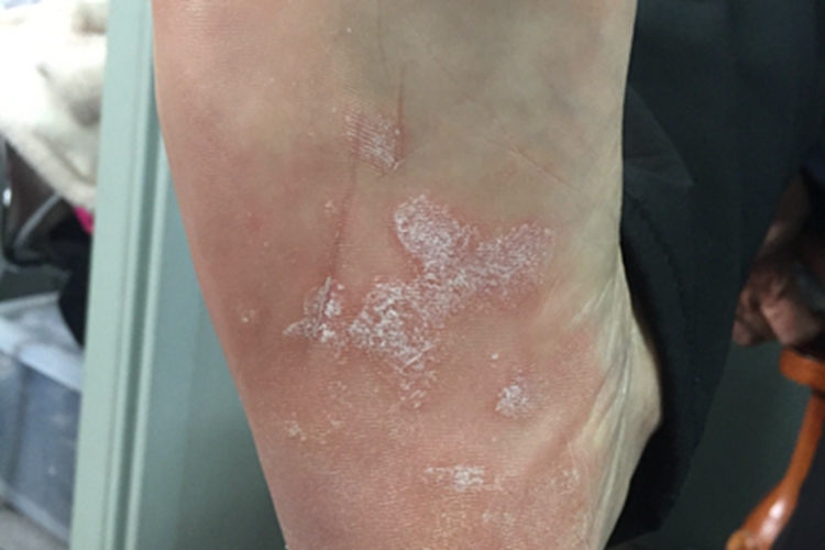 进行性掌跖角化病脱屑图 进行性掌跖角化病脱屑图