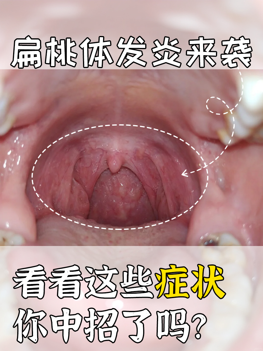 扁桃体发炎来袭，看看这些症状你中招了吗？