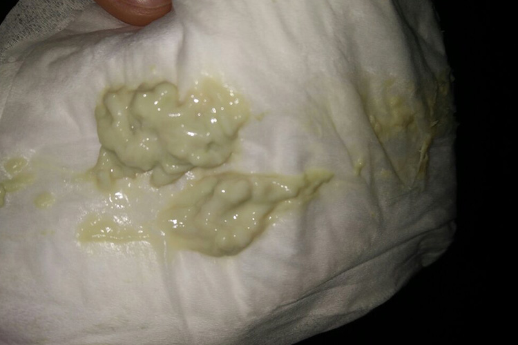 外阴阴道假丝酵母菌病凝乳状分泌物图 外阴阴道假丝酵母菌病凝乳状分泌物图