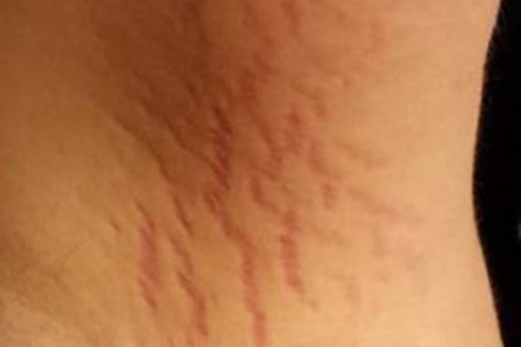 妊娠纹腋窝下有红色凹陷纹图